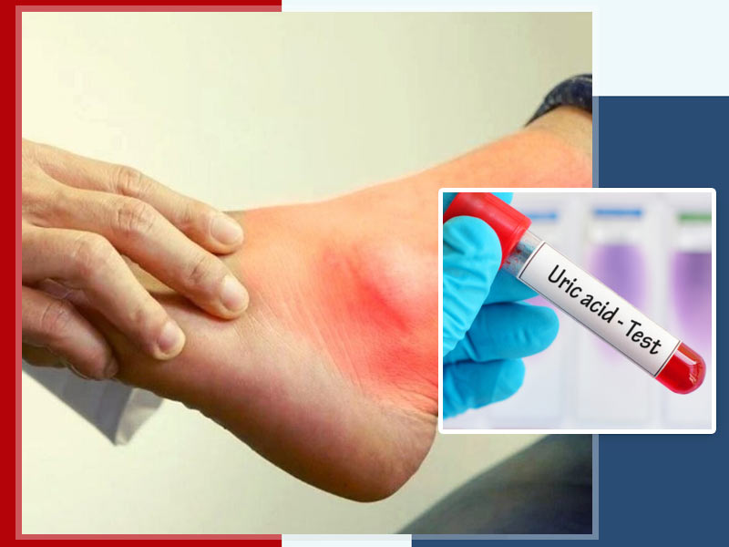 Top 7 Foods to Manage Uric Acid Levels