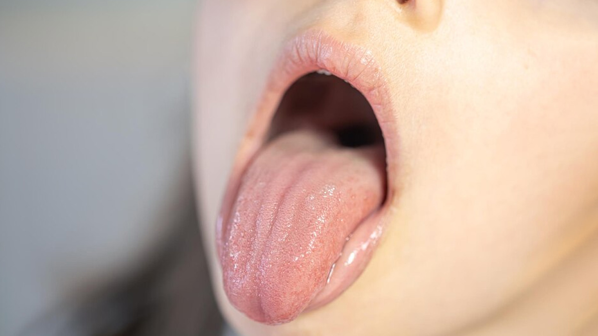 tongue bite remedy