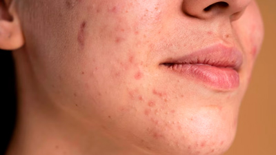 Hormones Could Be Causing Your Chin Acne: Here's How To Get Rid Of Them