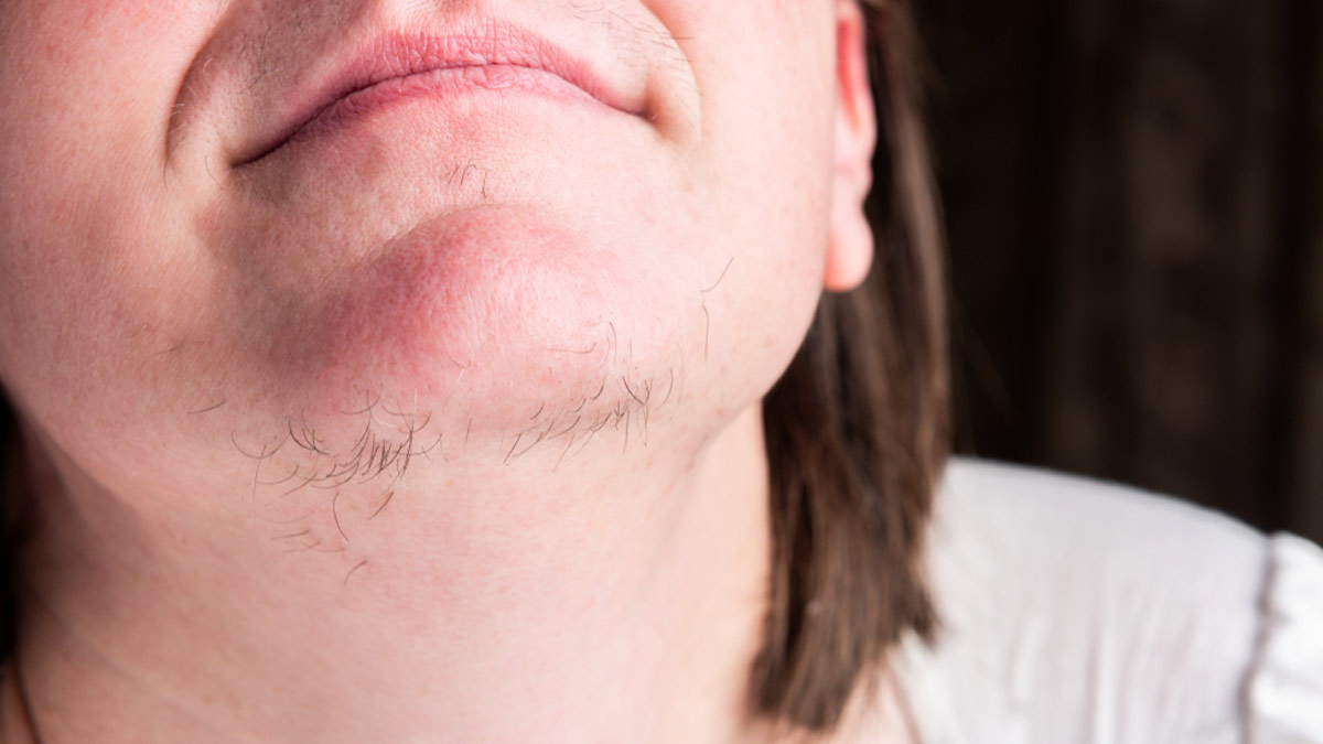 Worried About Facial Hair? Home Remedies To Reduce Its Appearance