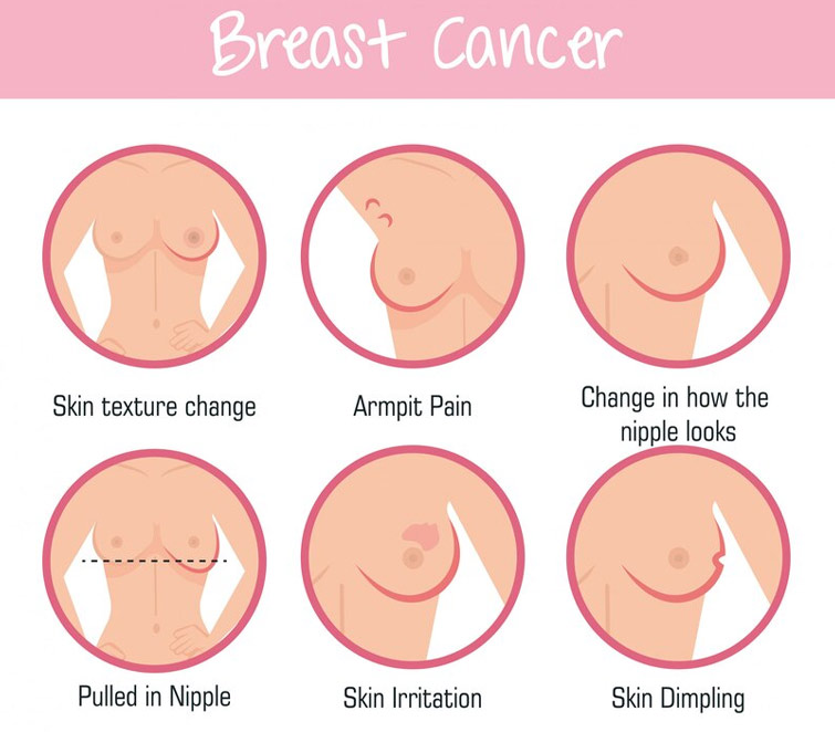 Stage 4 Breast Cancer Symptoms
