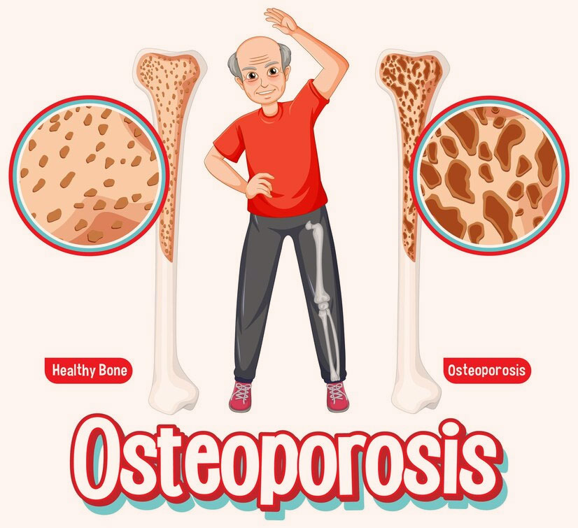 Osteoporosis