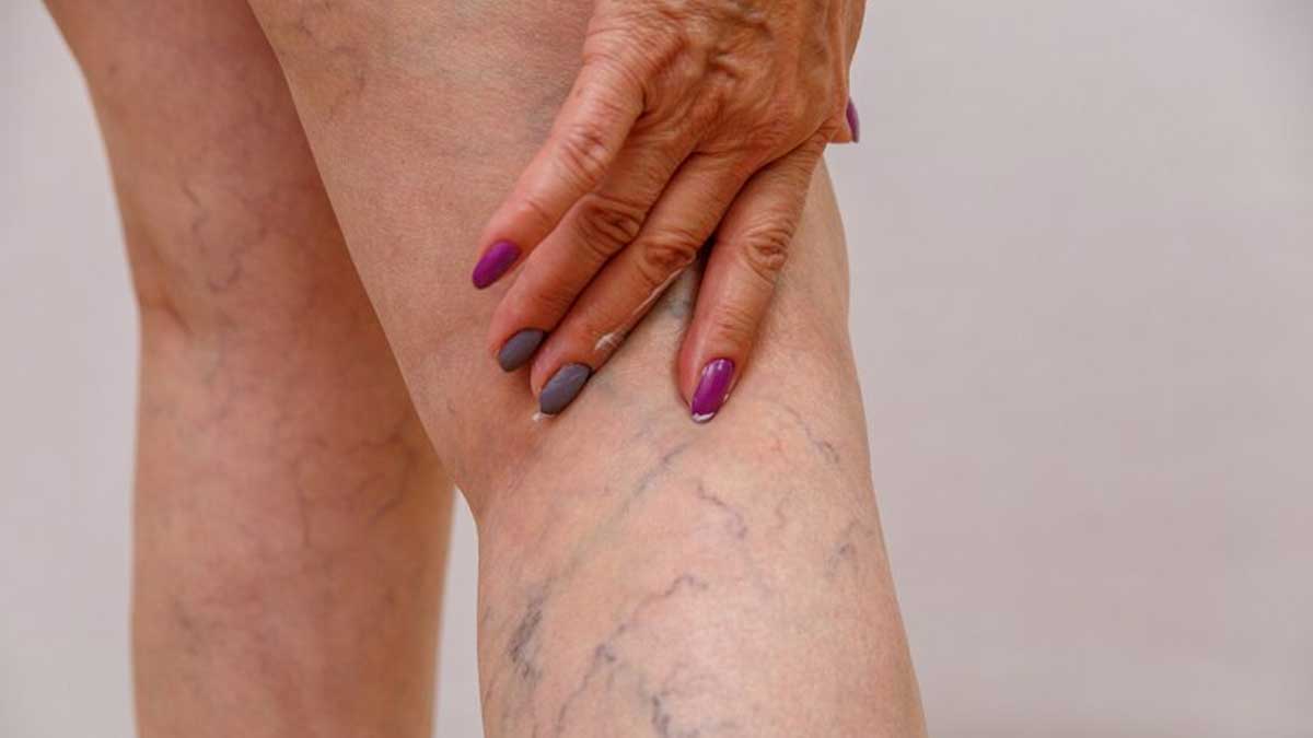 How To Stop Deep Vein Thrombosis From Coming Back