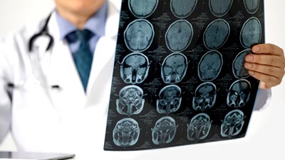 About 80% Of Strokes Are Preventable: Here Are 5 Ways To Cut Down Your Risk