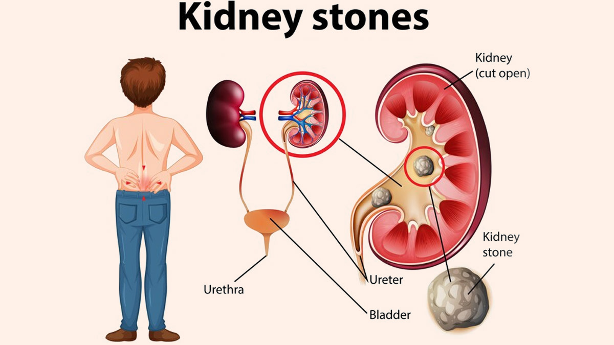 Tips To Recover After Kidney Stone Surgery