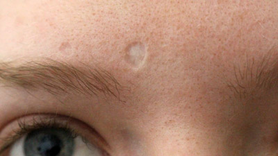 Chickenpox Scars Occur In 18% Of Infections: Expert Shares Causes, Precautions, And Treatment