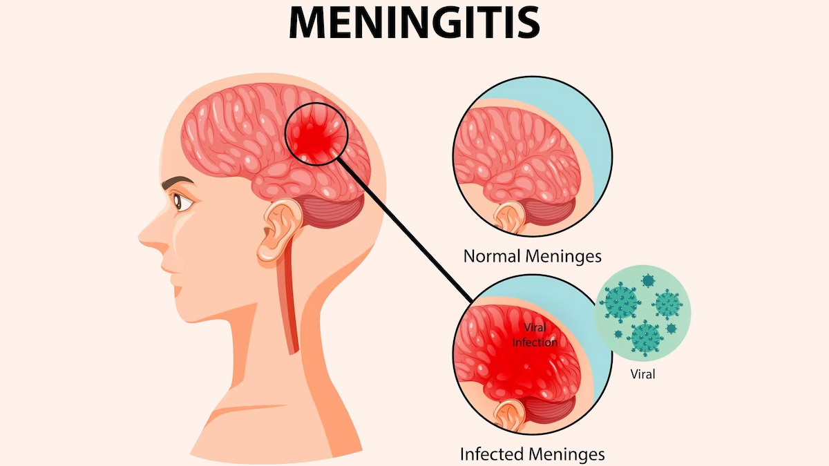Meningitis: Here Are Symptoms And Ways To Tackle 