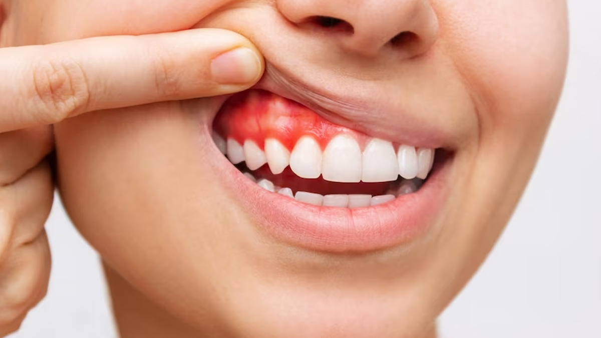 Advantages of Gum Restoration
