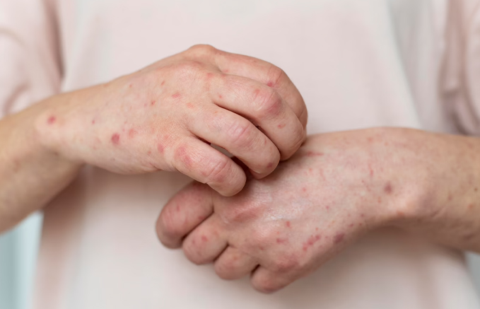 New Strain Of Chickenpox Causing Virus