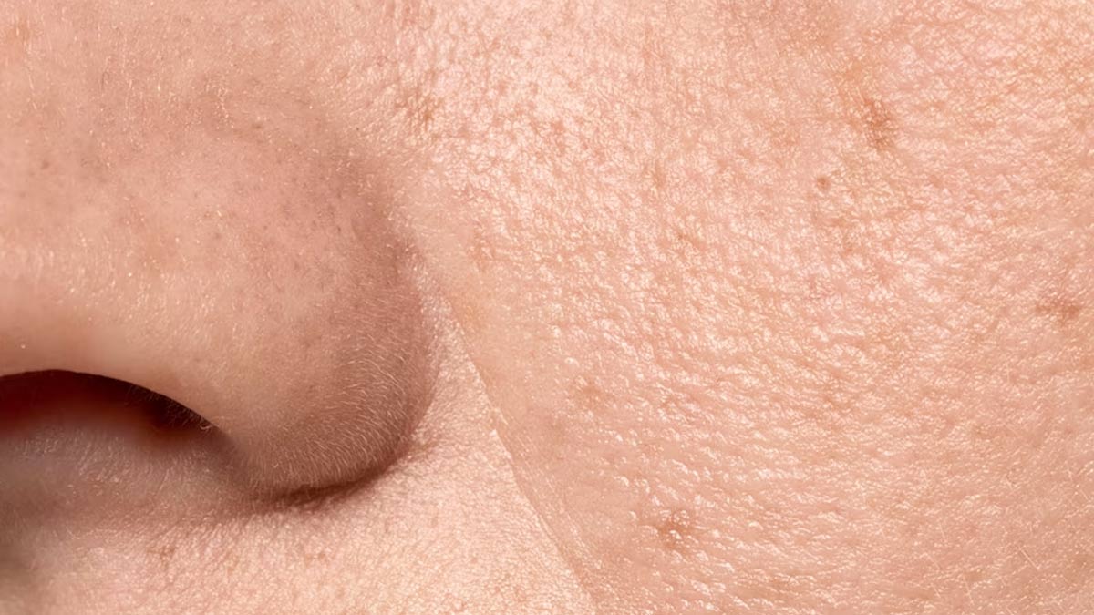 open-pores