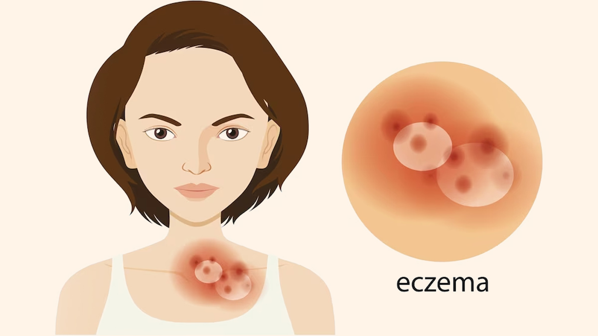 Is It Eczema? How To Identify You Are Suffering From This Skin Disease 