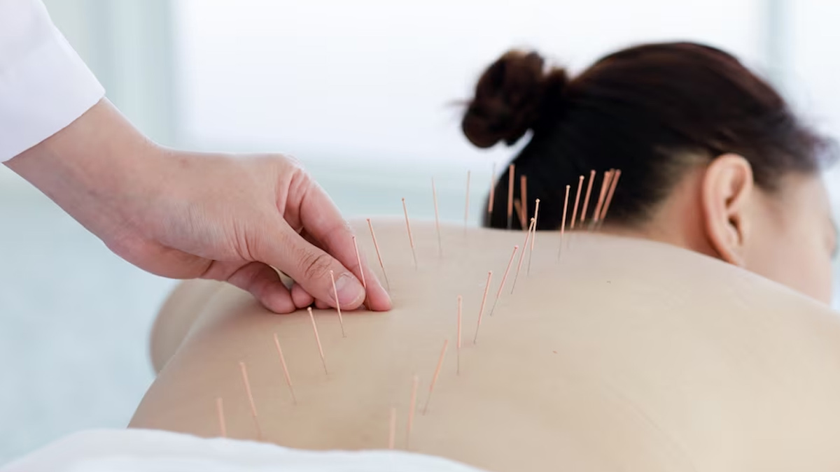 acupuncture