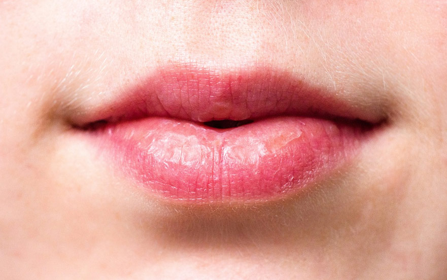causes of dry lips