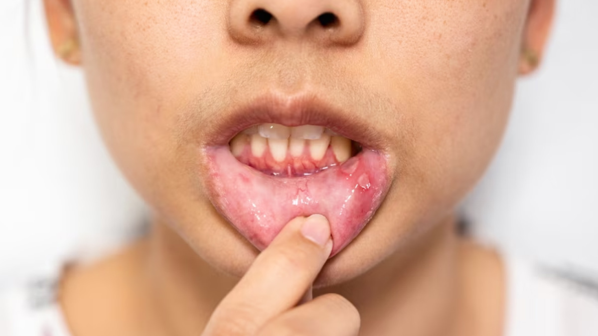 mouth-ulcer