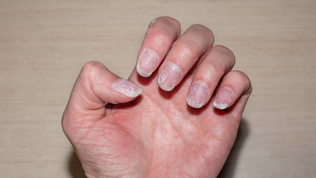 Warning Signs Of Psoriasis