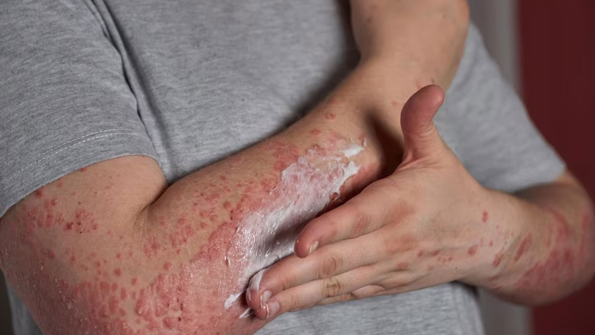 Unmasking Psoriasis: Here Are 6 Warning Signs You Should Know