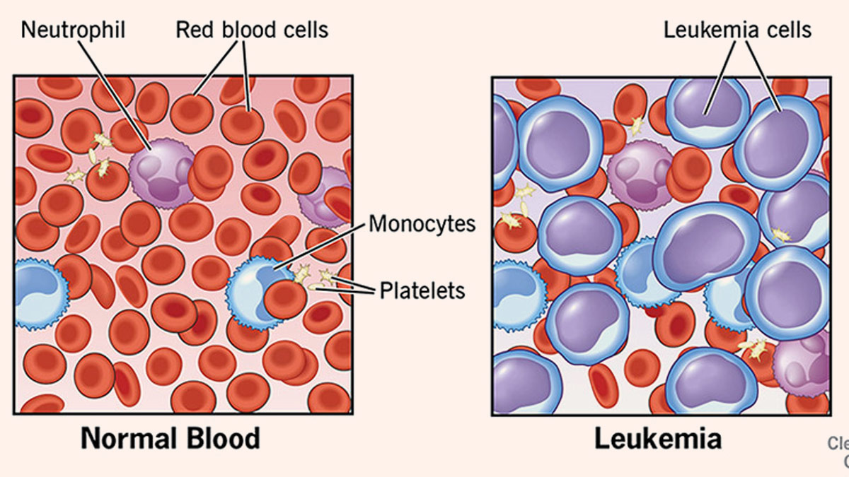 Leukemia