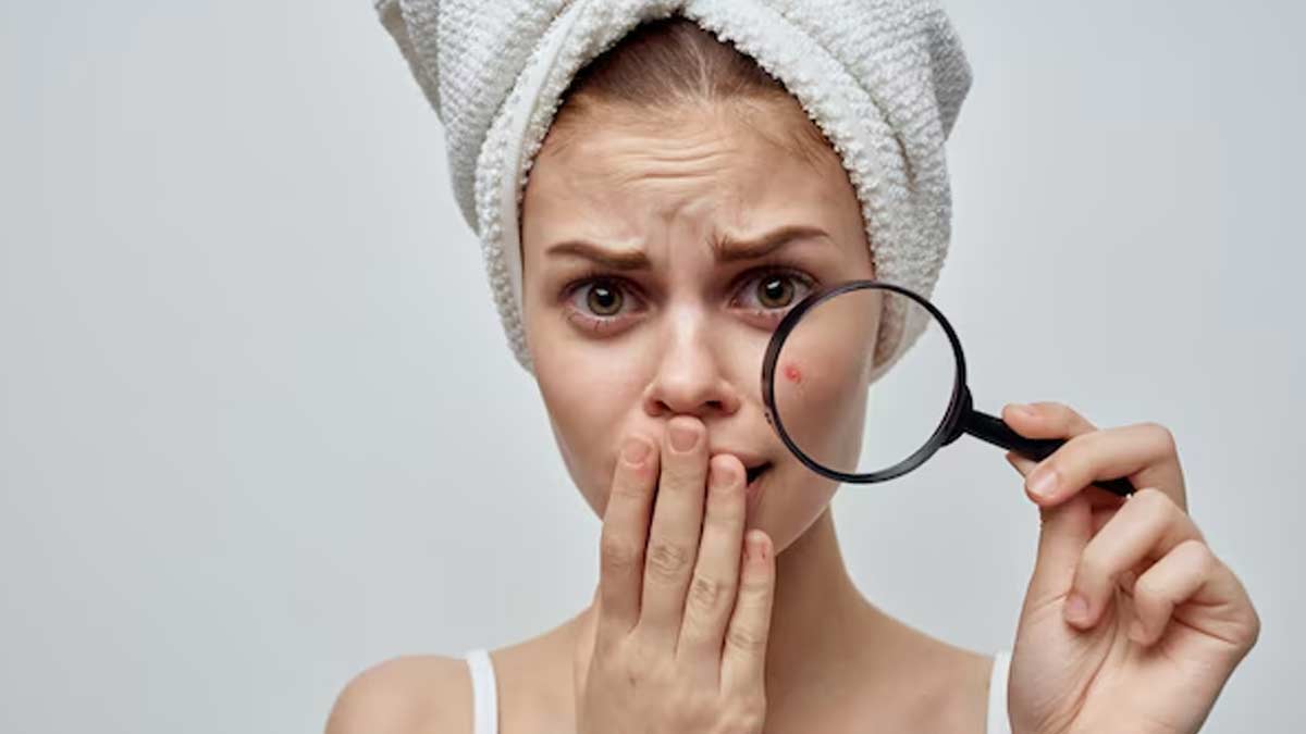 Can Dry Skin Cause Acne In Hindi