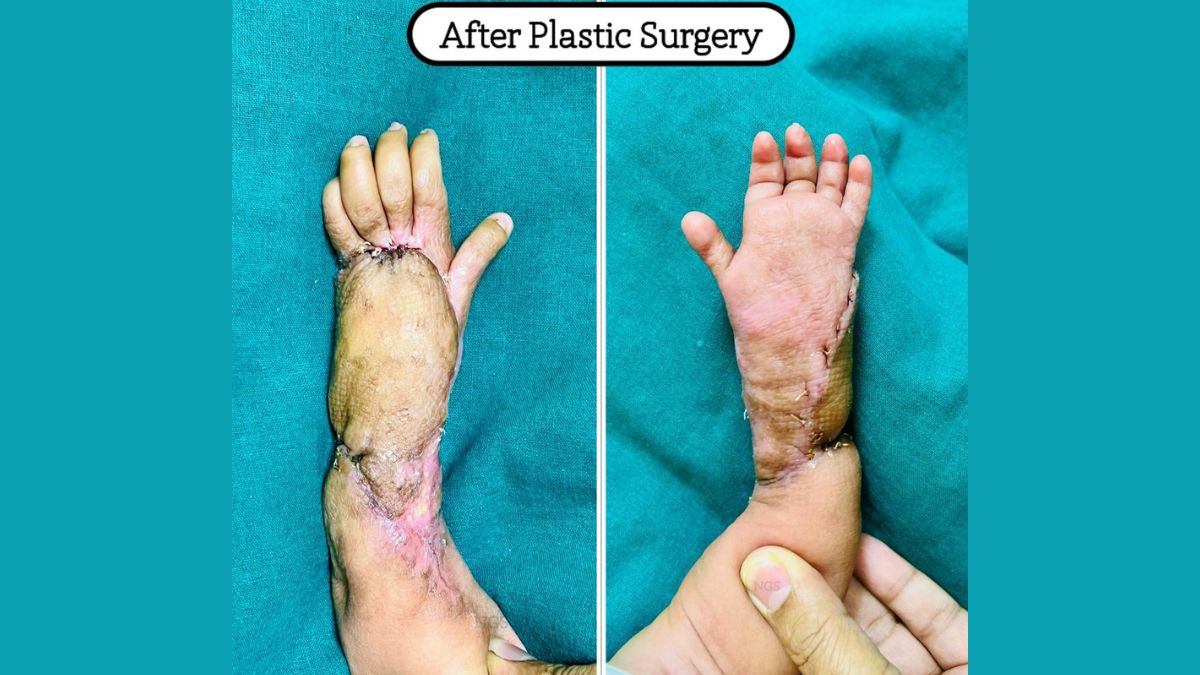 Timely Intervention Triumphs: How 2-Month-Old Girl Avoided Amputation Despite Necrosis From Severe Cellulitis