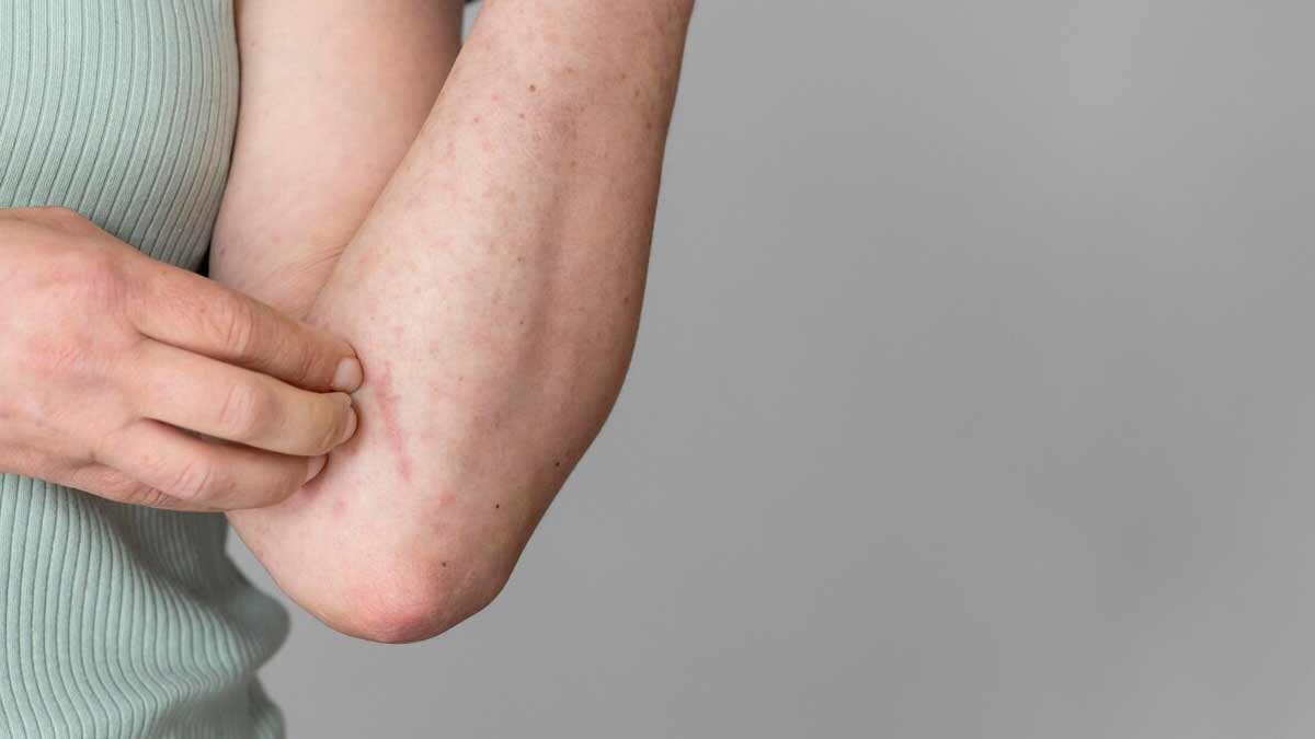 Are Hives Contagious Know In Hindi