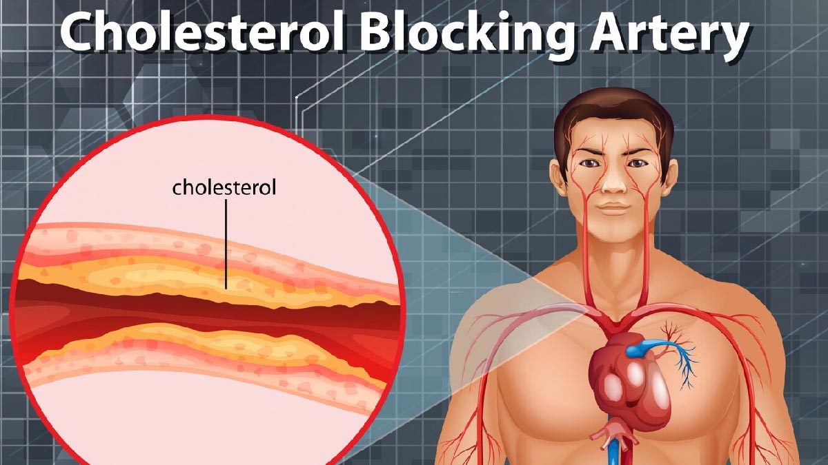 Tips To Reduce High Cholesterol At Forty In Hindi