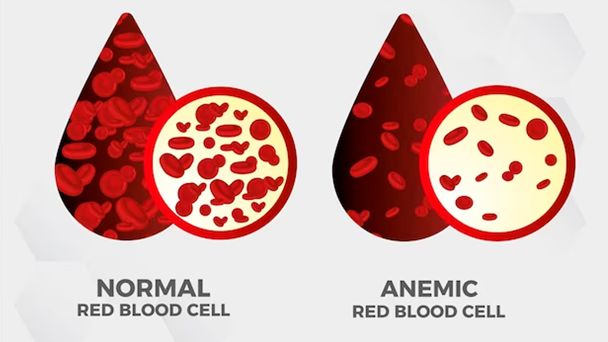 diamond blackfan anemia