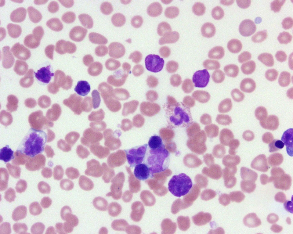 T Cell Lymphoma