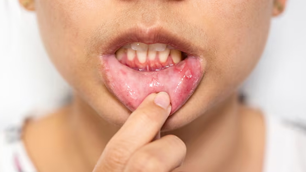 What To Drink To Get Rid Of Mouth Ulcers In Hindi