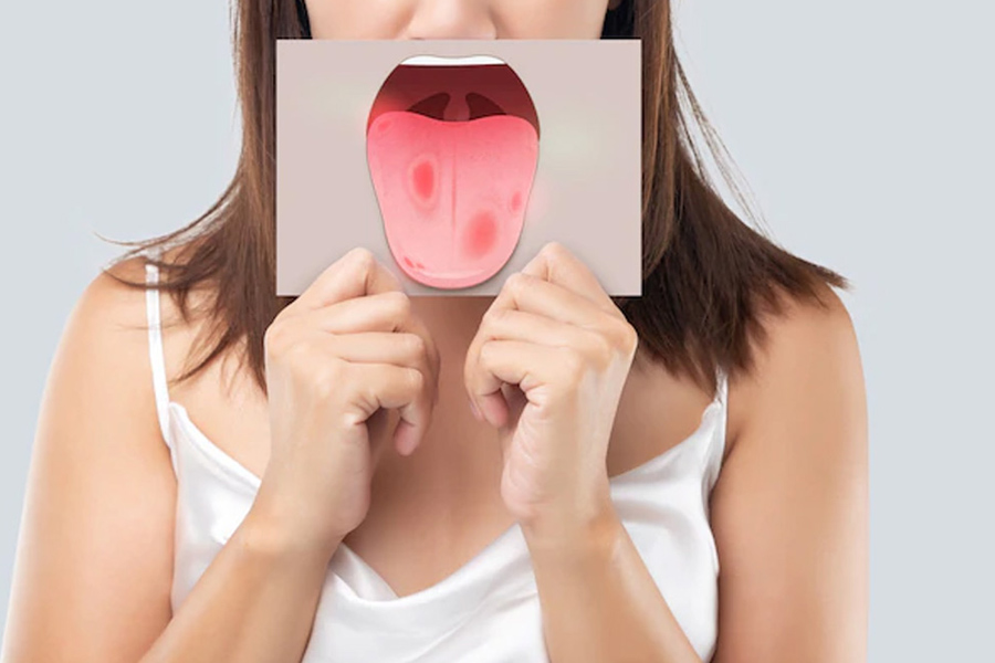 mouth burning home remedies