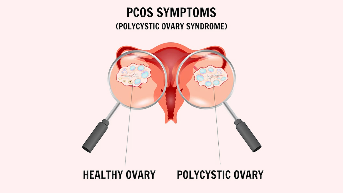 PCOS