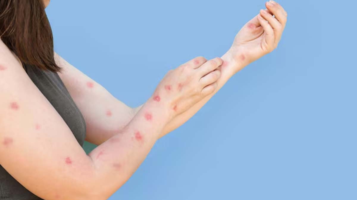 monkeypox diagnosis