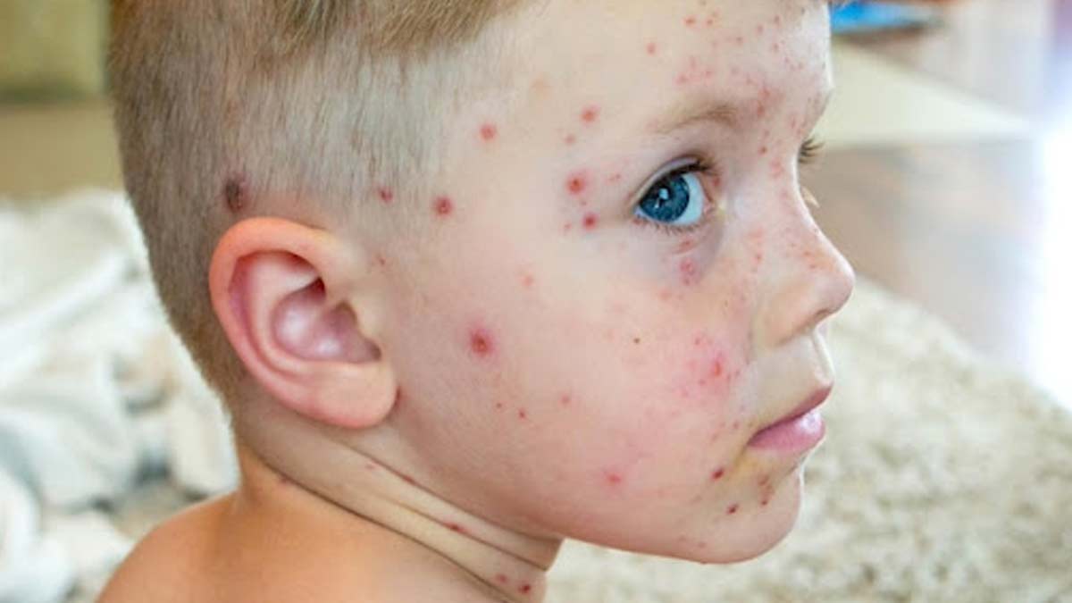 monkeypox vs measles symptoms