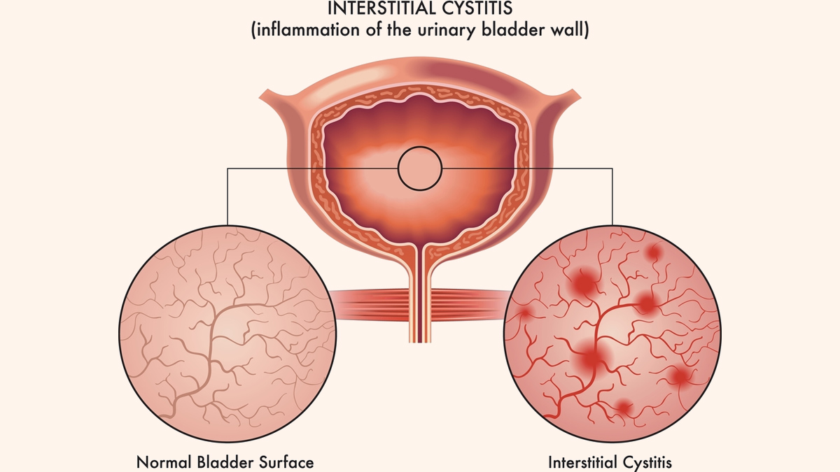 interstitial-cystitis
