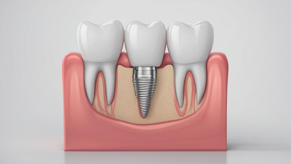 dental-implant