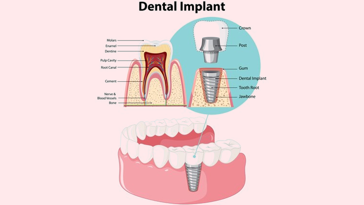 fixed-dental-implant