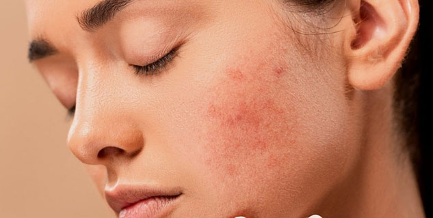 Expert explains link between stress and skin conditions