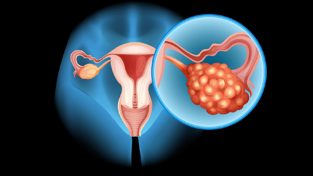 Effective Tips That Can Help You Get Quality Sleep When Dealing With PCOS