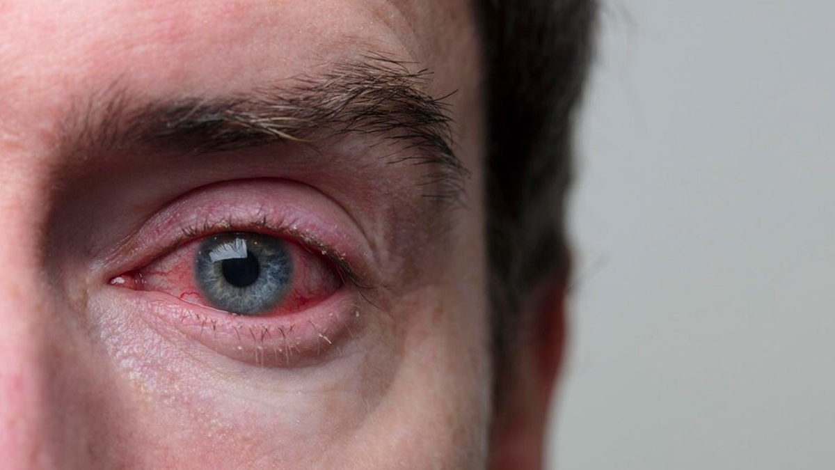 Here Are Some Eye Complications During Winter And Tips To Prevent It