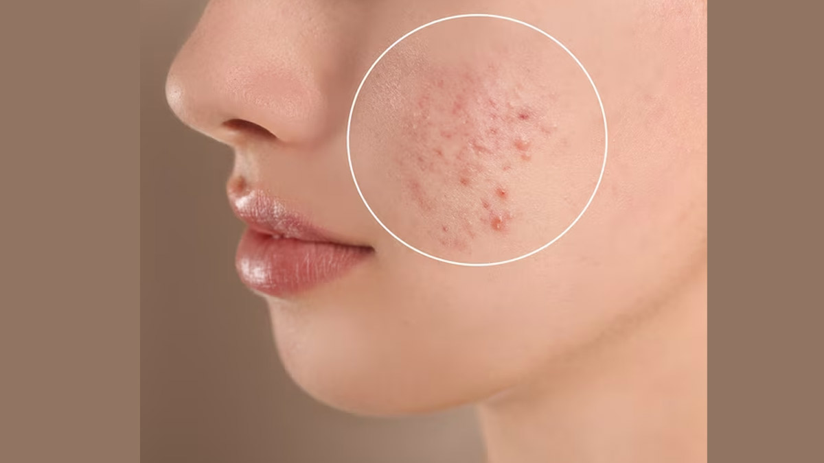 fungal acne prevention tips