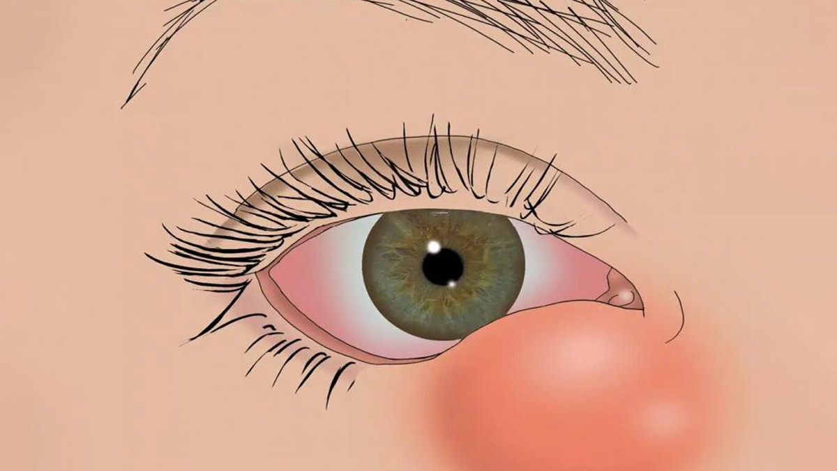 tear duct infection symptoms