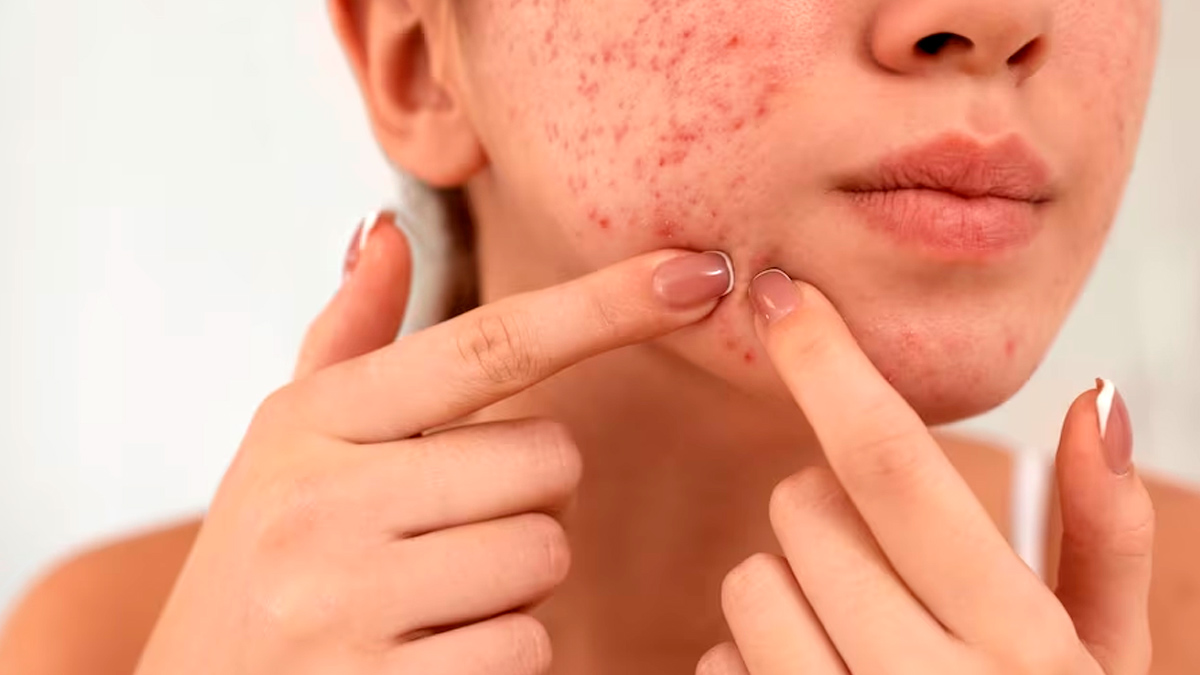 causes of frequent or constant acne