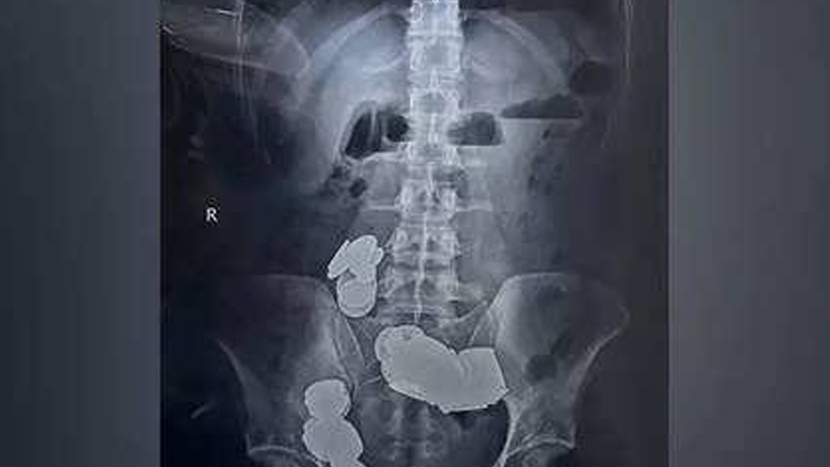 Man Swallows 39 Coins, 37 Magnets For A Zinc Rich Diet, Gets Hospitalised: Here Are Better Alternatives