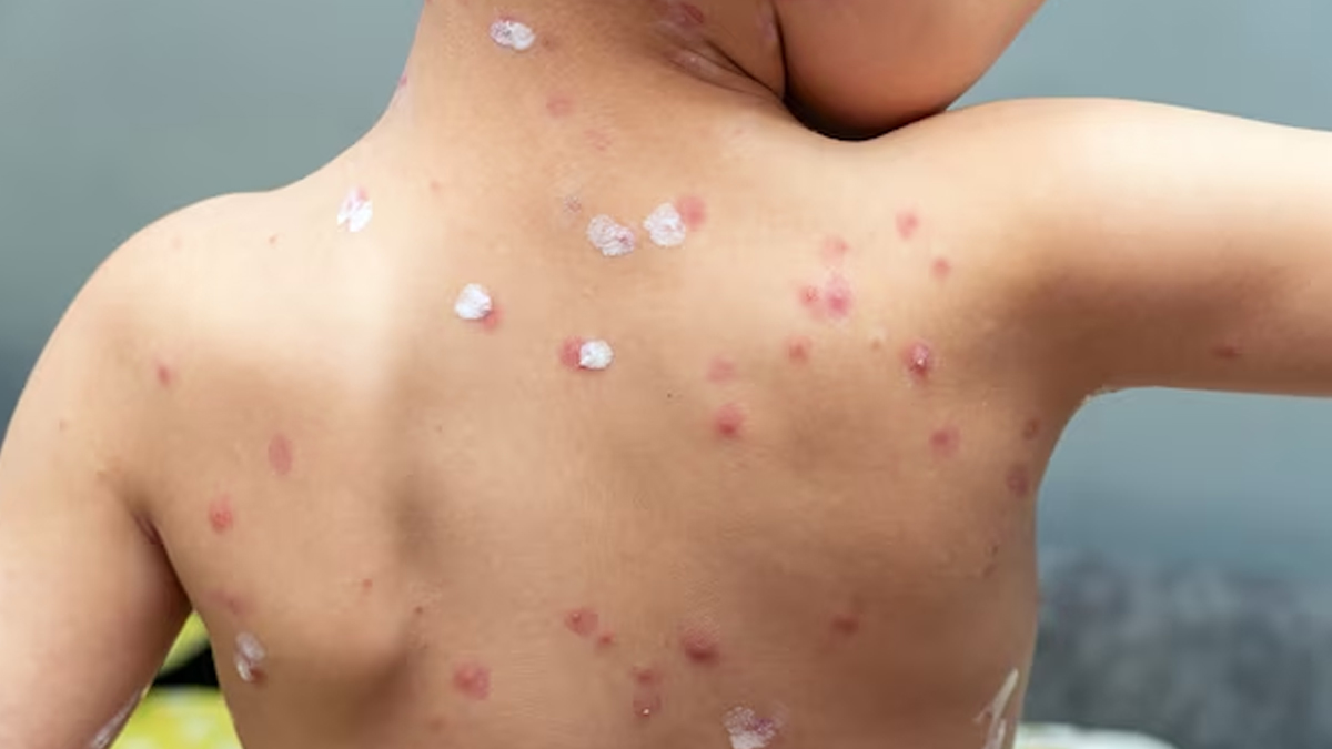 Mumps Could Cause An Epidemic In 2024, Claims IAP: Here Are Its Risk Factors, Preventive Measures