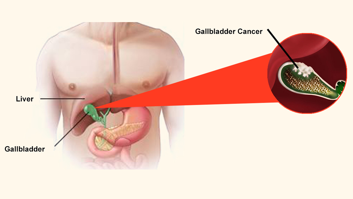 Gallbladder Cancer