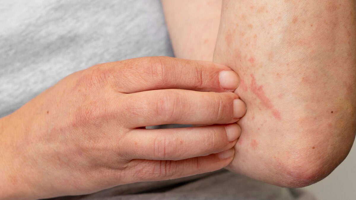 serum sickness treatment