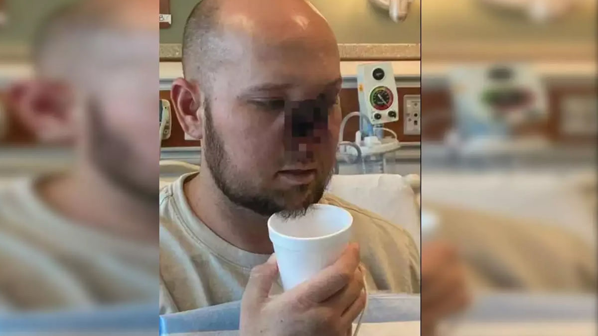 What Is Aplastic Anaemia, Autoimmune Disorder That Caused US Man To Lose His Nose