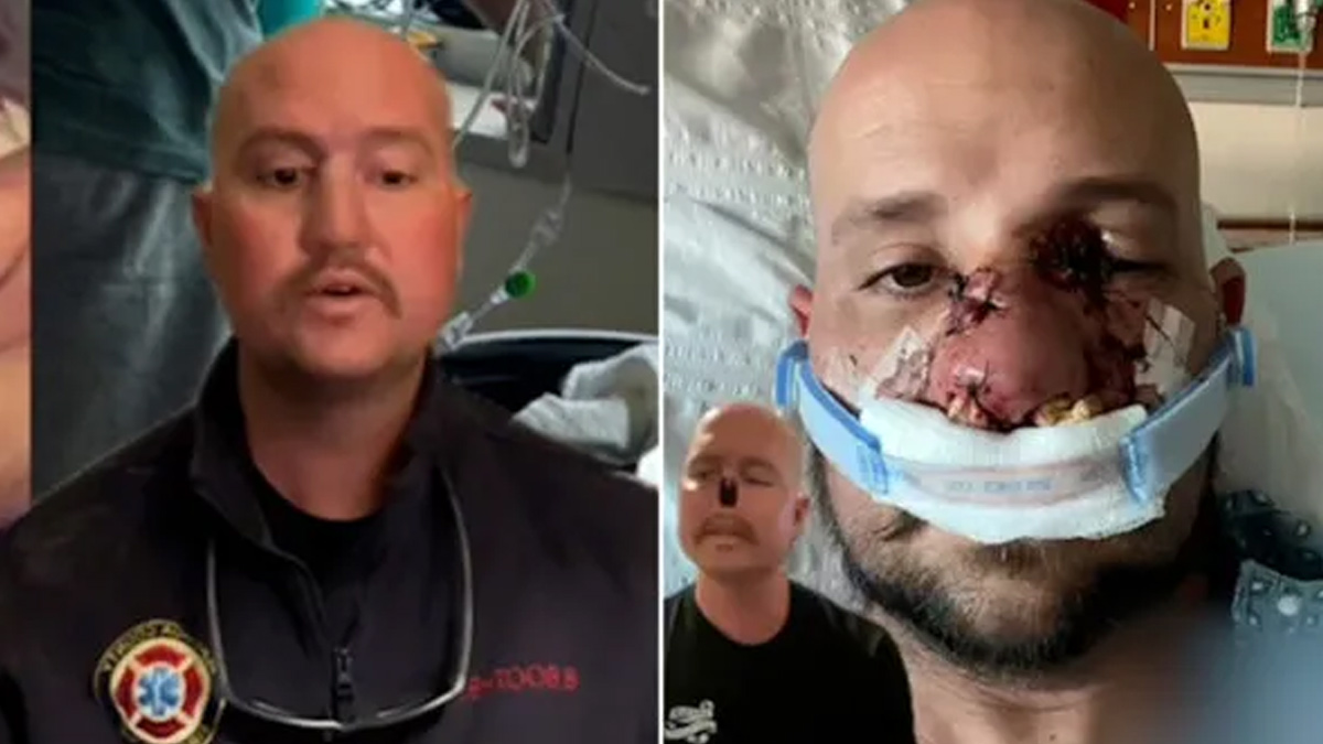 What Is Aplastic Anaemia, Autoimmune Disorder That Caused US Man To Lose His Nose