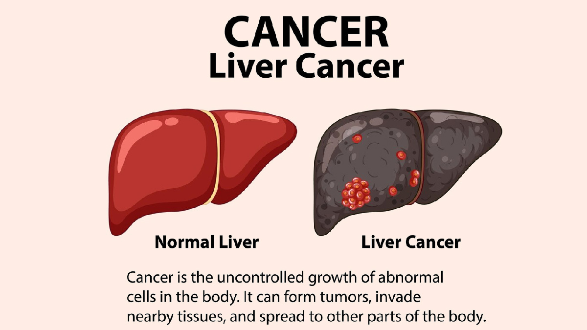 Here's How You Can Prevent Cancer Due To Untreated NAFLD