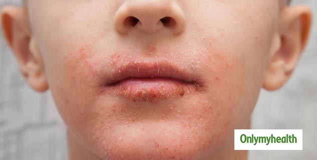 Ways to get rid of flaky skin around your mouth