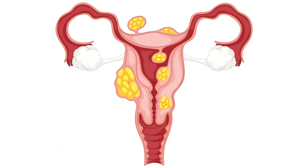 Fibroids In The Uterus
